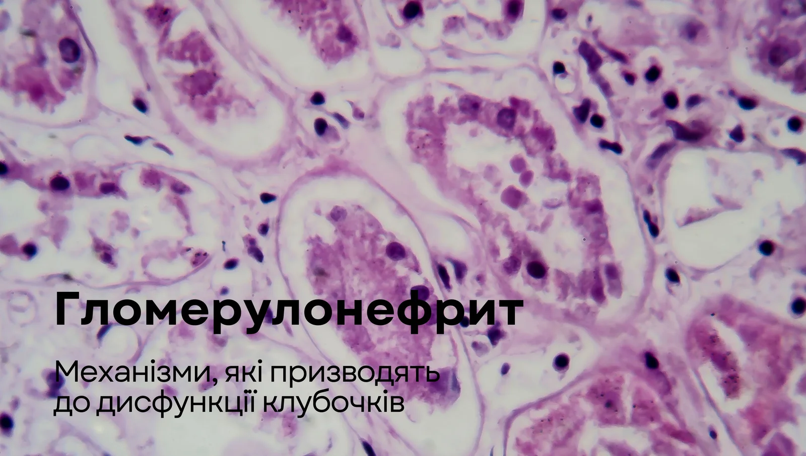 Гломерулонефрит