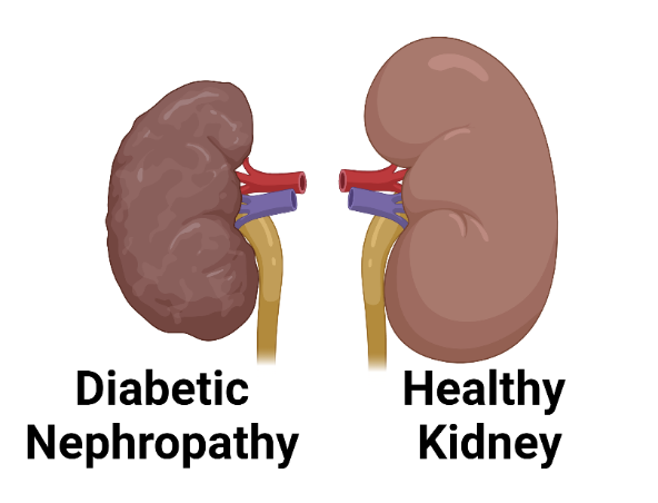 diabetic-kidney-disease-nephrocenter